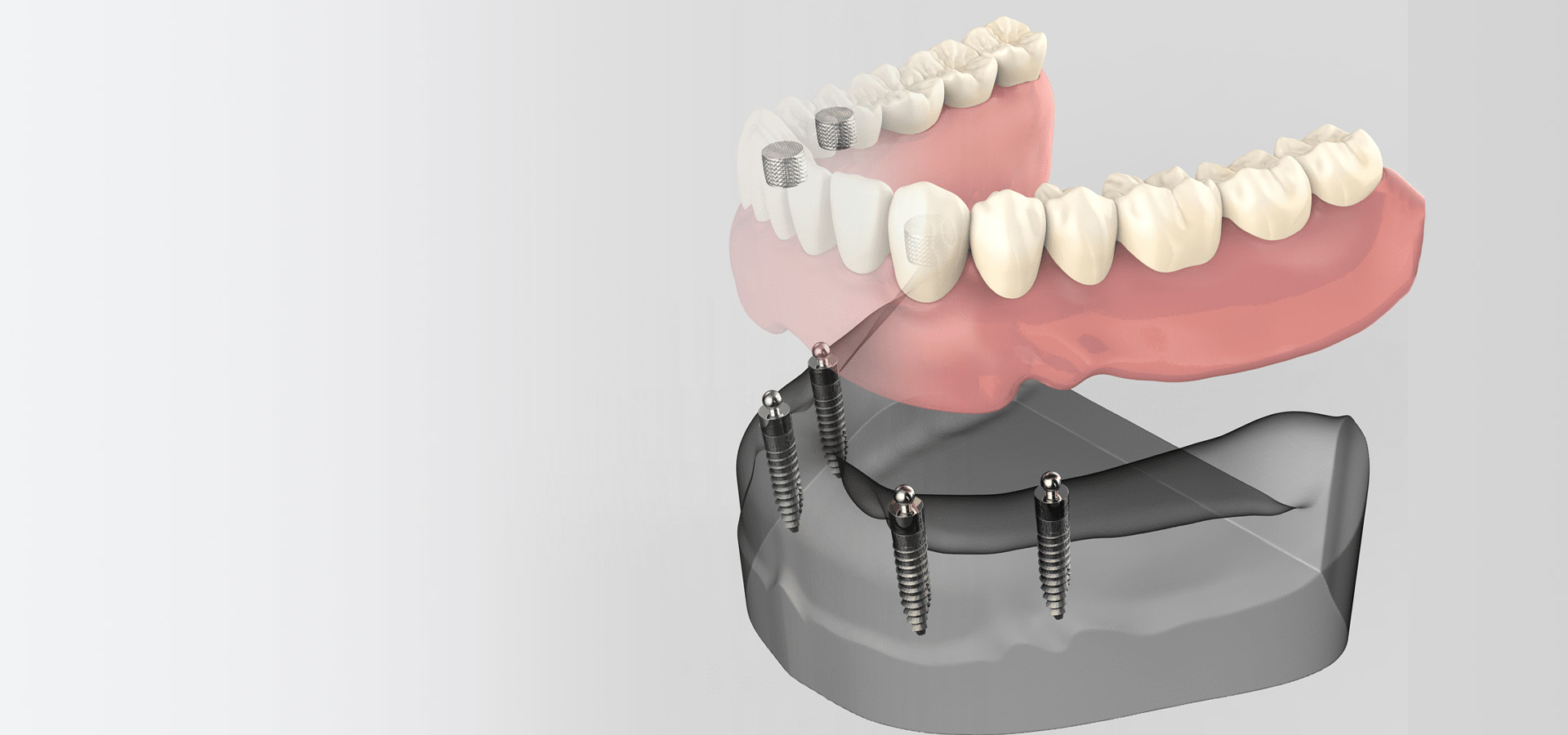 Advanced Implant Surgery